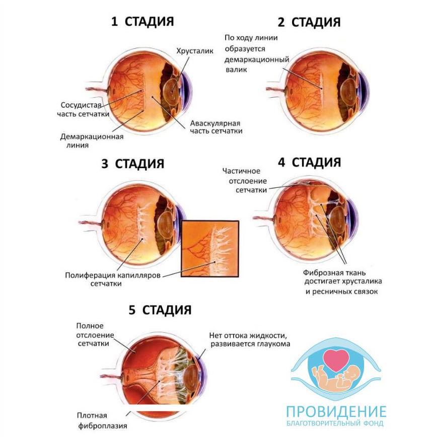 Стадии ретинопатии и их лечение