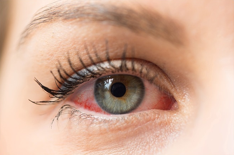Аллергия глаза